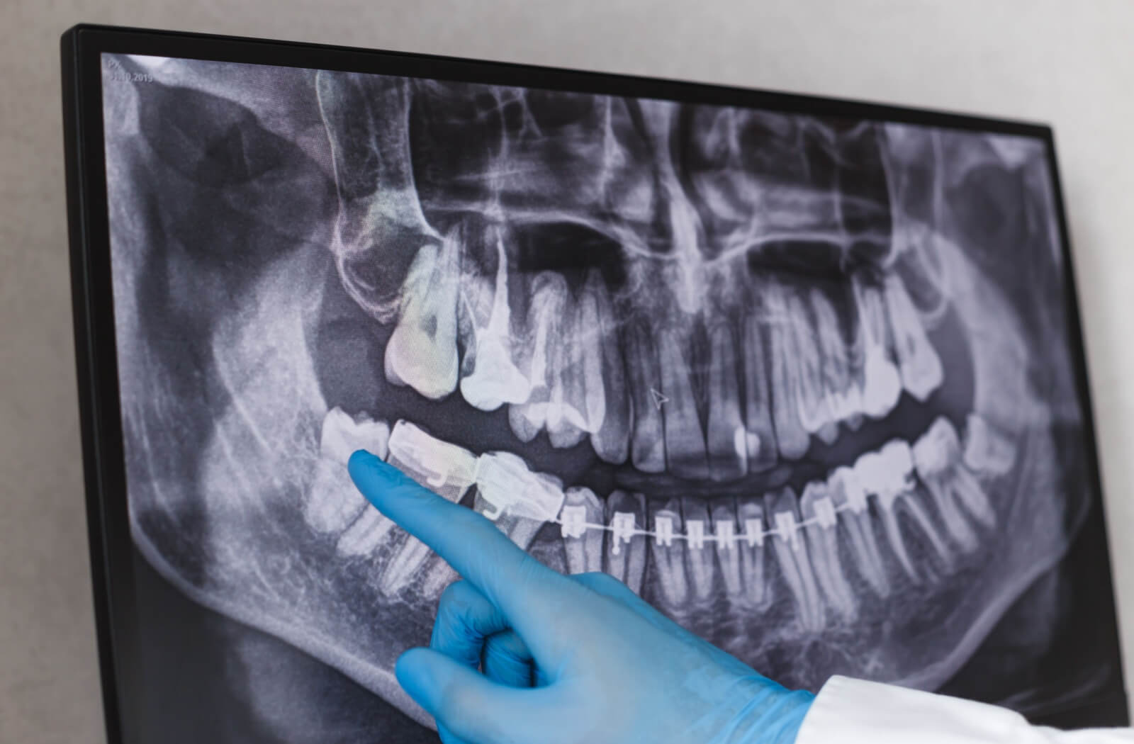 A professional points to an erupting wisdom tooth on an x-ray of a young person's teeth.