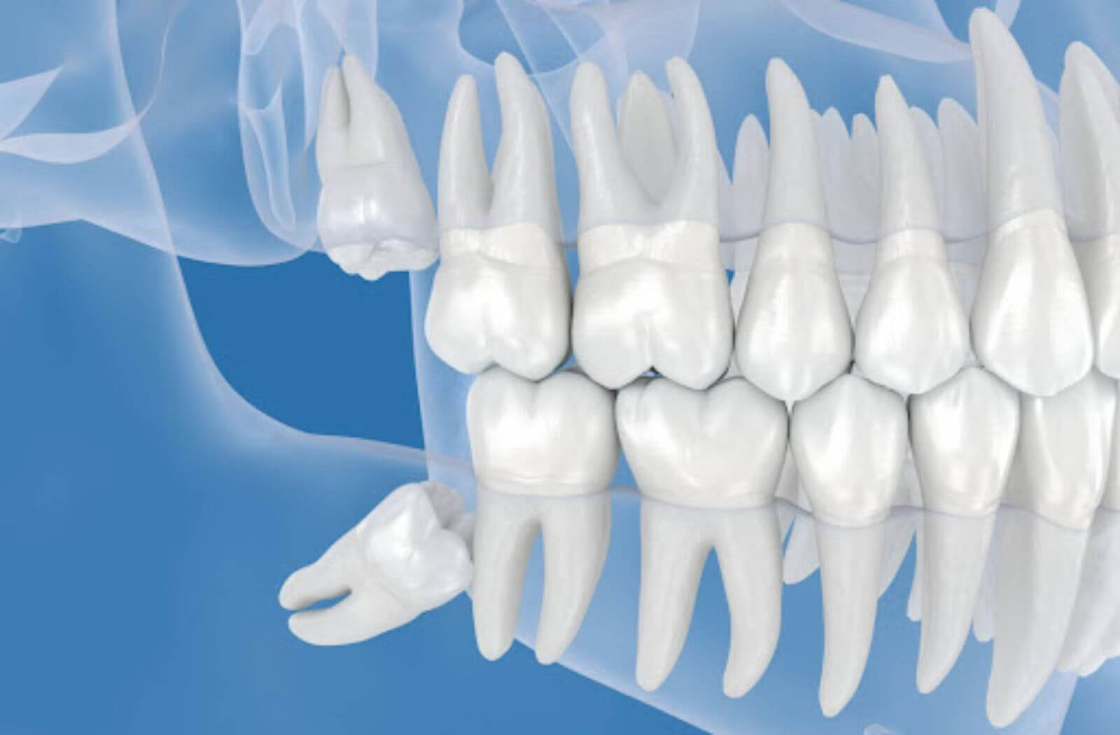 A rendered image of wisdom teeth