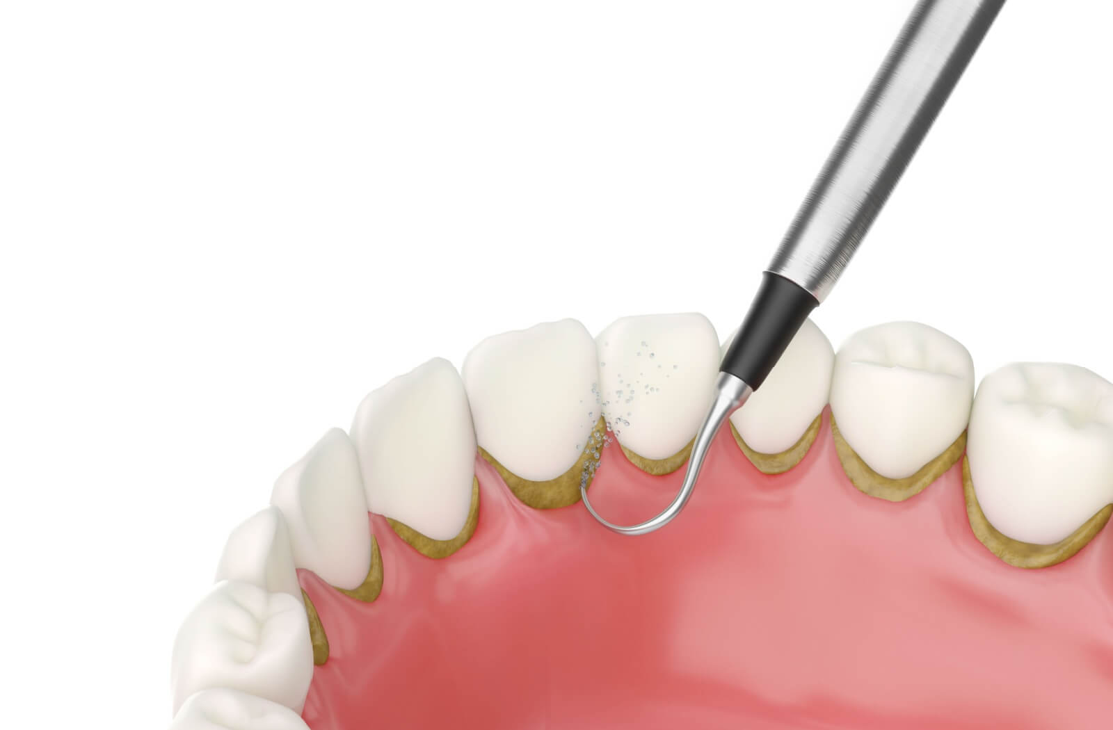 A digital illustration of a dental tool cleaning plaque from a row of teeth and gums.