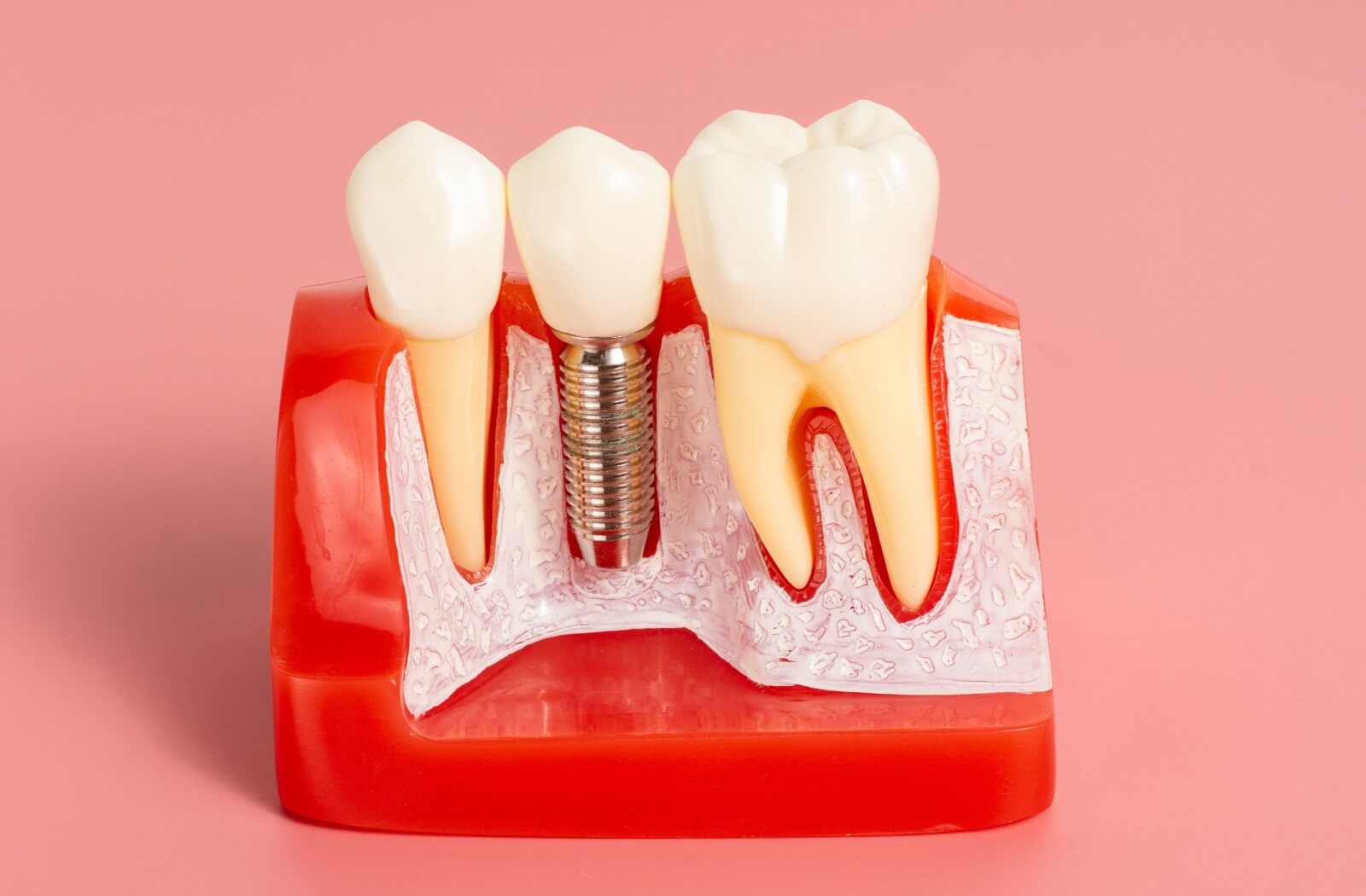 A dental model showing a cross-section of a tooth implant.